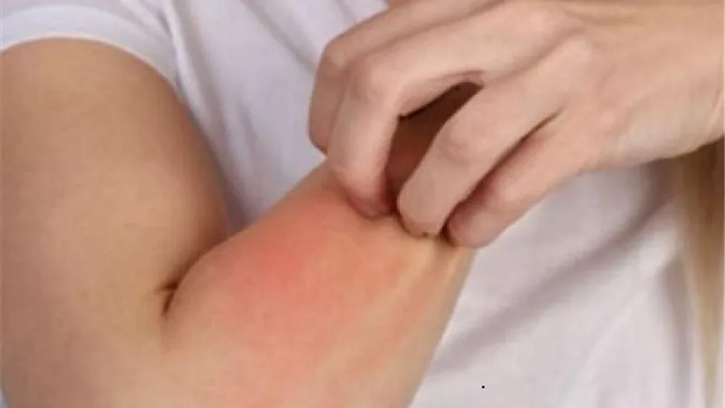 نصائح عند علاج حساسية الجلد من الحرارة