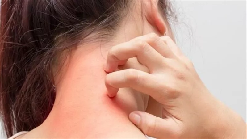 7 طرق طبيعية لعلاج التسلخات للكبار