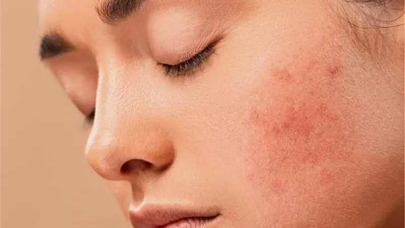 اهم طرق لعلاج ندوب الوجة