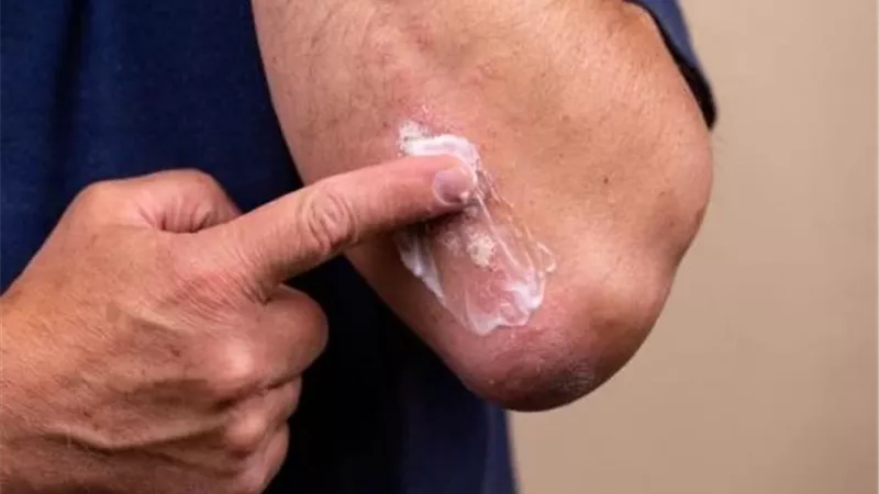 طبيب يكشف الفرق بين العدوى الفطرية البسيطة والخطيرة