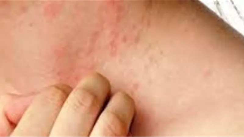 طبيب أمراض جلدية يكشف أفضل طريقة لعلاج