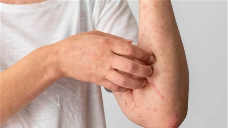 احترس من لدغات الناموس ..يسبب حمى الضنك وينقل أمراض خطيرة