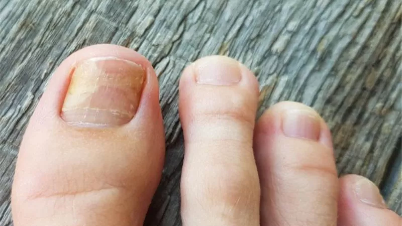 هل فطر الاظافر من الامراض المعدية؟ تعرف على الاسباب وطرق العلاج