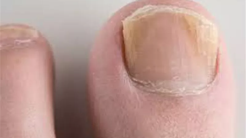 كيف نقي أظافرنا من الإصابة بفطر؟