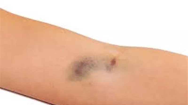 تعرف على أسباب ظهور الكدمات