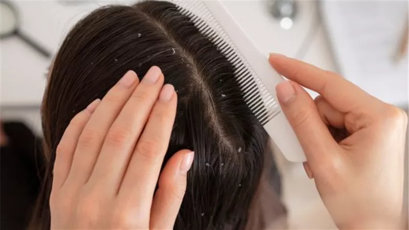 افضل طريقة لغسل فرشاة شعرك إذا كنت تعاني من القشرة