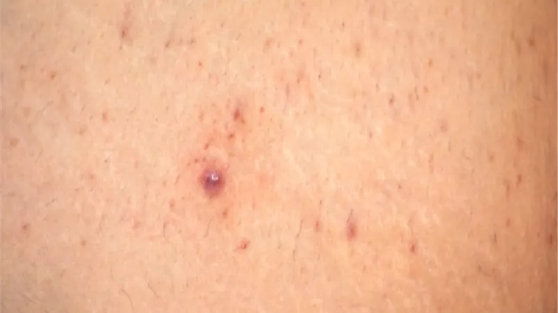 5 طرق منزلية لعلاج الشعر تحت الجلد