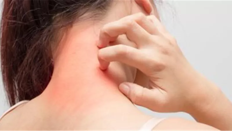 تعرف على اسباب ظهور مرض الصدفية بالجلد