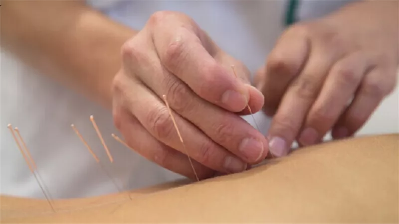منظمة الصحة العالمية توضح موقفها من تقنية الوخز بالإبر