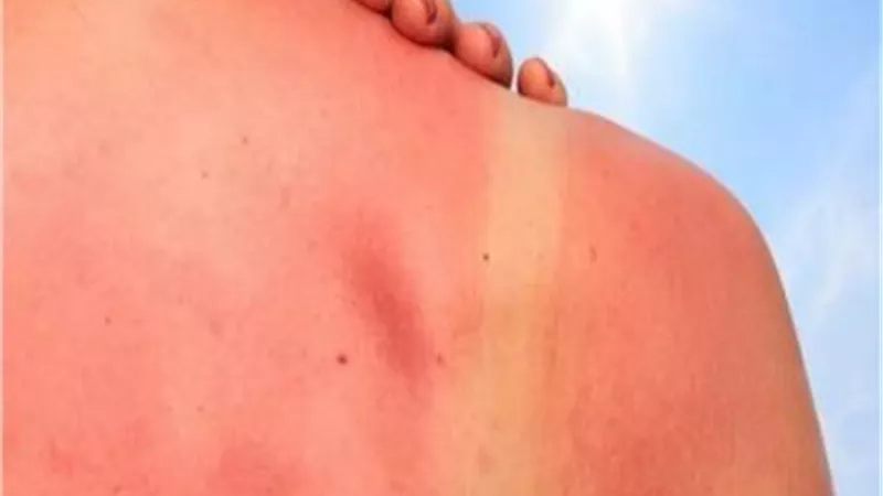 احمى نفسك من حروق الشمس بهذه الخطوات