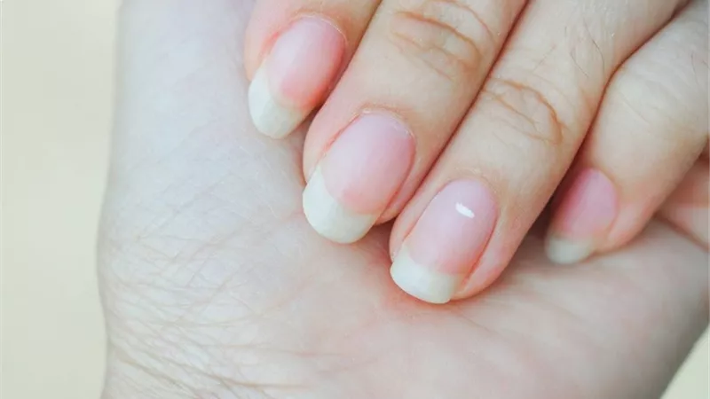 طبيب يدحض أسطورة شائعة بخصوص البقع البيضاء على الأظافر
