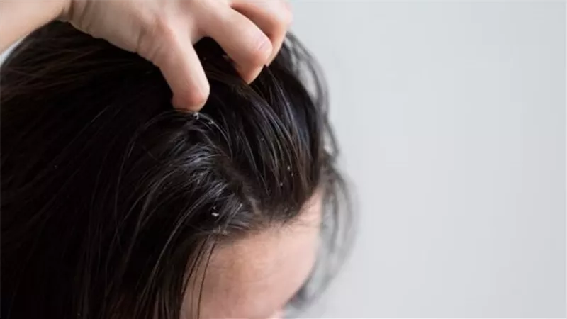 تخلصي من قشرة الشعر بمكونات طبيعية
