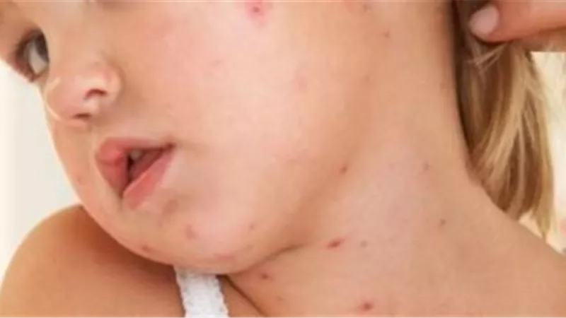 ما هي اسباب واعراض الحصبة ؟ طبيب يجيب
