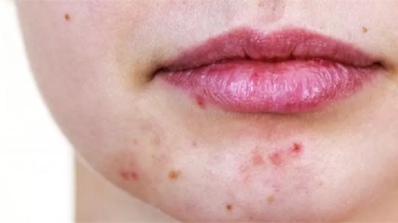 طرق طبيعية للتخلص من آثار الحبوب.. تعرف عليها