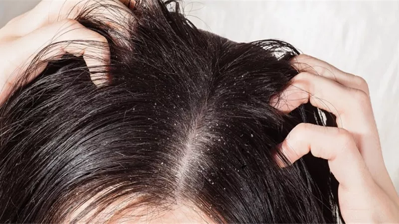4 طرق طبيعية لعلاج قشرة الشعر