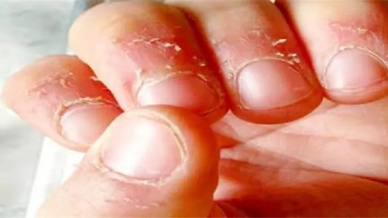 تعرف على أسباب تقشر الجلد حول الأظافر