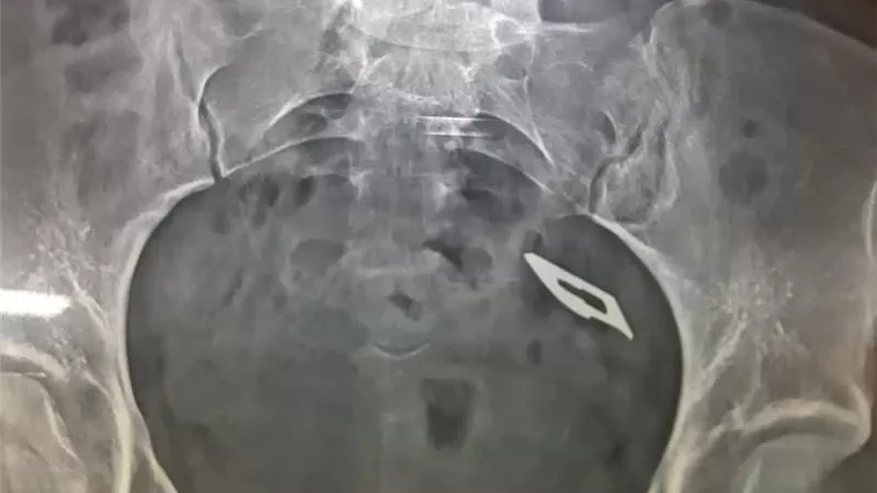 استخراج مشرط جراحي من داخل أمعاء فتاه بمستشفي المنصورة التخصصي