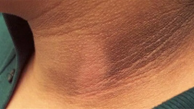 أبرز أسباب سواد الرقبة.. ارتفاع مستويات الإنسولين بالدم