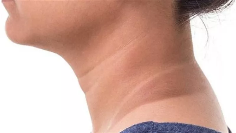 5 خطوات لتخلص من خطوط العنق