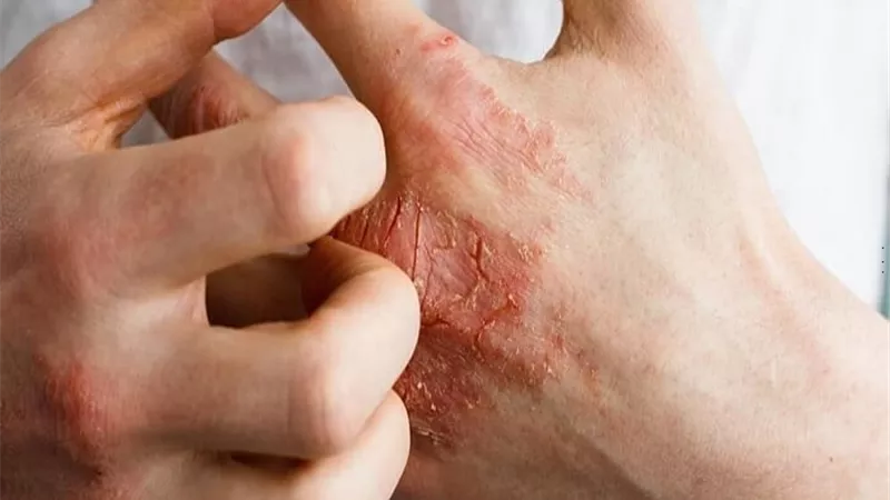 4 خطوات لعلاج الاكزيما فى المنزل