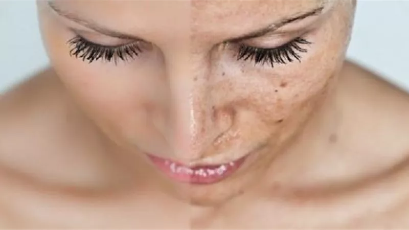 10 وصفات منزلية لعلاج الكلف