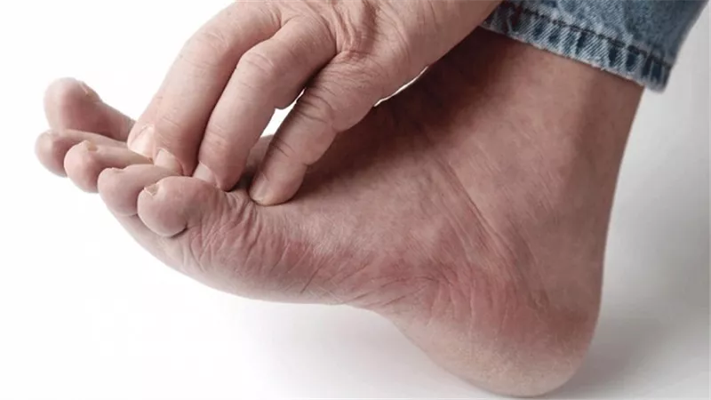 تعرف على علاج فطريات القدم منزليًا